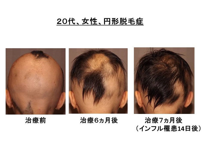 円形脱毛症　病院""